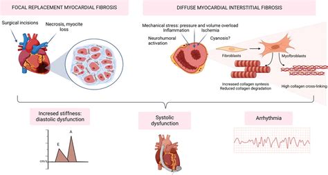 Frontiers Myocardial Fibrosis In Congenital Heart Disease