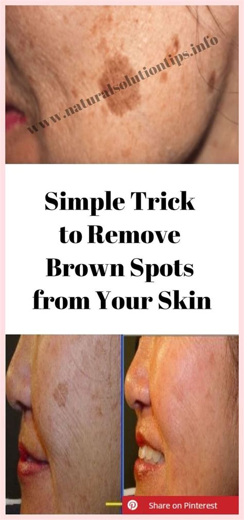 Brown spots on skin – Artofit