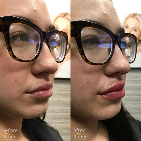 Before After Lip Filler Injections Illume Cosmetic Surgery Medspa