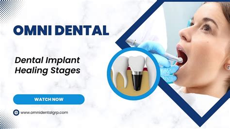 Dental Implant Healing Stages Youtube