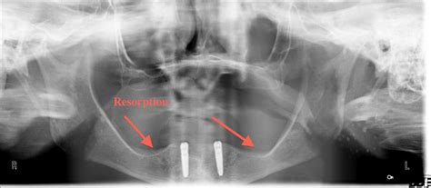 A case for Fixed hybrid prosthesis vs. the removable overdenture