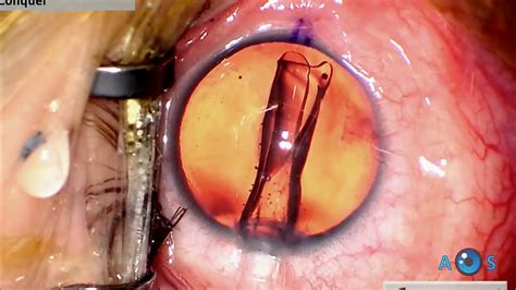 Visian ICL EVO Toric For High Myopic Astigmatism Lens Loading And