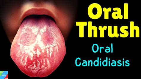 Oral Thrush | Oral Candidiasis – Symptoms, Causes, Diagnosis, Treatment ...