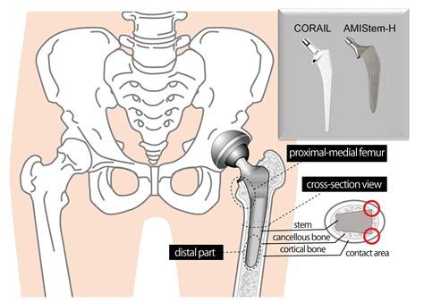 Staying hip to orthopedic advances: comparing traditional and new hip replacement stems | Asia