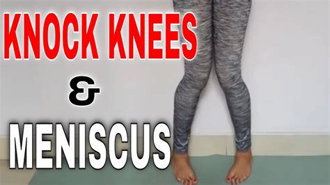 Knock Knees Yoga For Meniscus How To Get Stronger Knees Youtube