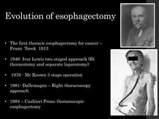 Mis Carcinoma Esophagus PPT