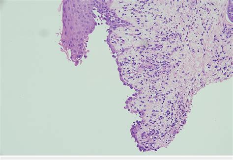 Features are of spongiotic dermatitis. Spongiosis within the epidermis ...