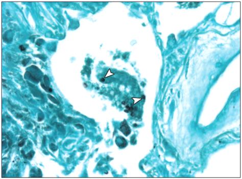 Pneumocystis Jiroveci Pneumonia High Resolution Ct Findings In Patients With And Without Hiv