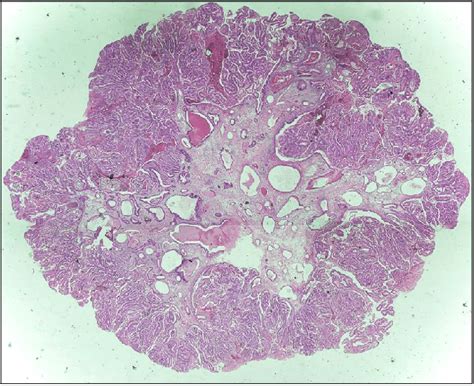 Microscopic Feature Of The Adenomatous Polyp The Polyp Composed Of Download Scientific Diagram