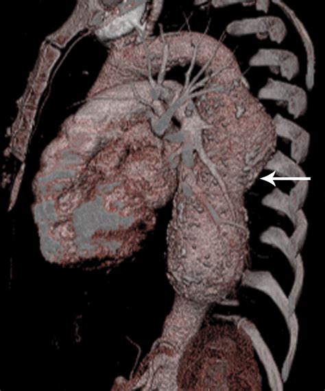 Thoracic Aortic Stent Grafts Utility Of Multidetector Ct For Pre And