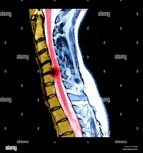 Mri Of A Cervical Herniated Disc High Resolution Stock Photography And ...