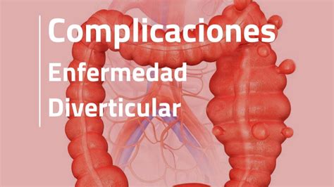 Complicaciones De La Enfermedad Diverticular