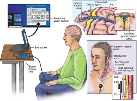 Stentrode Based Bci For Multi Click Computer Control Used By An