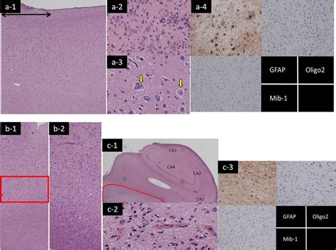 Neuropathological Findings Temporal Lobe Cortex A The Correct