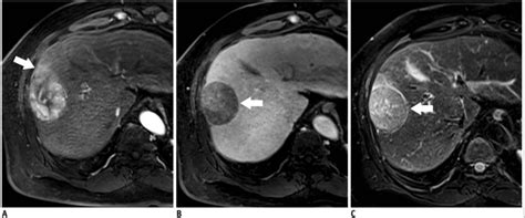 Nivolumab Approved By Fda For Liver Cancer National Cancer Institute