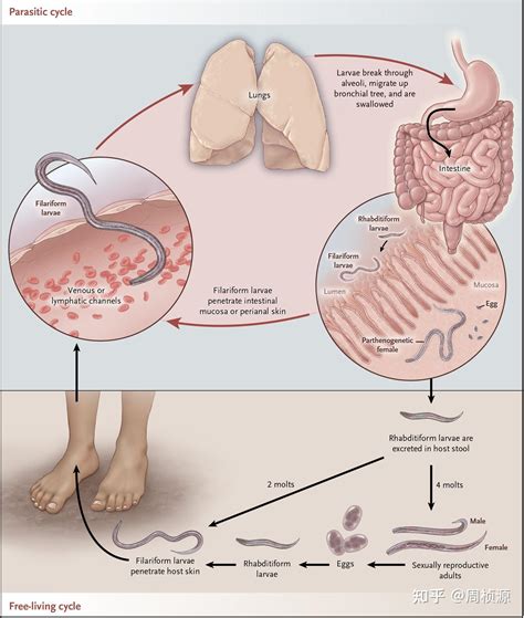 Nejm 2014 Case 28 知乎