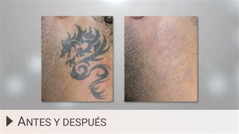 Eliminar tatuajes con láser Antes y después YouTube