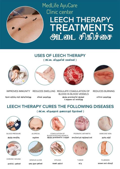 Leech therapy ( அட்டை விடல்)