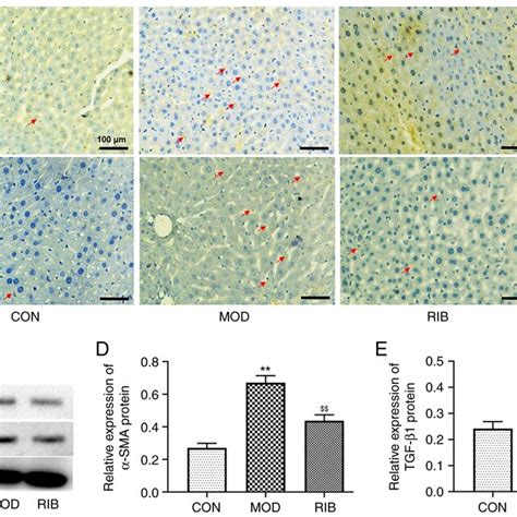 Immunohistochemical analysis and expression of α SMA and TGF β1