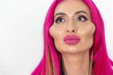 Model With Worlds Biggest Cheeks Shows What She Looked Like Before Filler Hot Lifestyle News