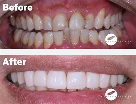 Veneers Before and After By Dr Kasen