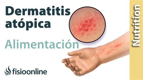 Importancia De La Nutrici N En El Desarrollo En La Dermatitis Ato