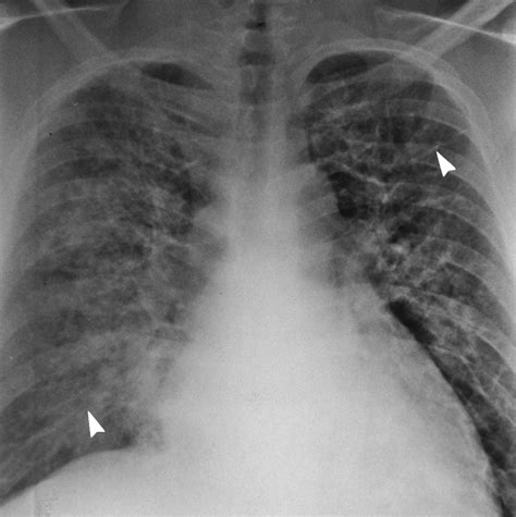 Clinical And Radiologic Features Of Pulmonary Edema RadioGraphics