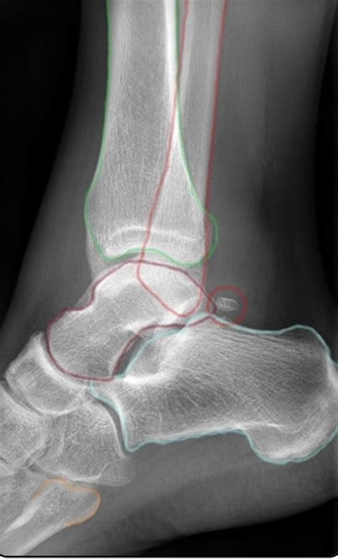 Ankle Lateral View Diagram Quizlet