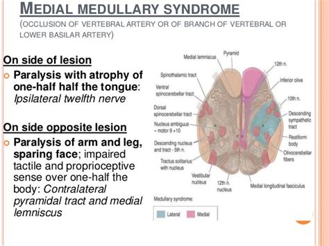 Pica Syndrome Stroke Saadmls