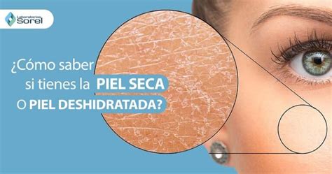 Piel Seca O Piel Deshidratada Laboratorios Sorel