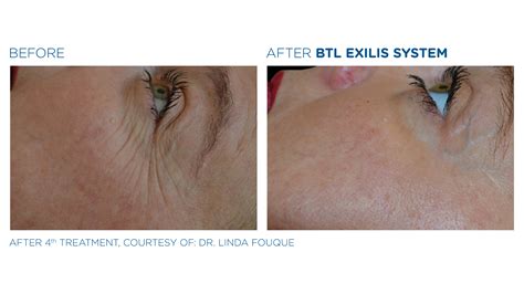 Skin Tightening Treatments In Columbus Ohio With Exilis Ultra