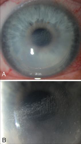 Diffuse Lamellar Keratitis