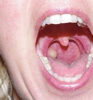 Throat Cyst On Tonsil Causes