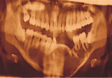 Orthopantomogram Of The Same Lesion Showing A Multilocular