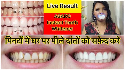 AGARO INSTANT TEETH WHITENER मनट म karen पल दत क सफद