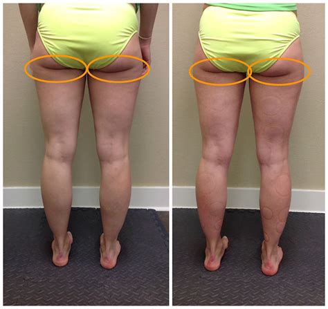 Cellulite Cupping Before And After Photos That Will Make 42 Off