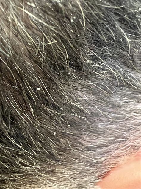 What Is Seborrheic Dermatitis On The Scalp Beverly Hills Dermatology Consultants™ Blog