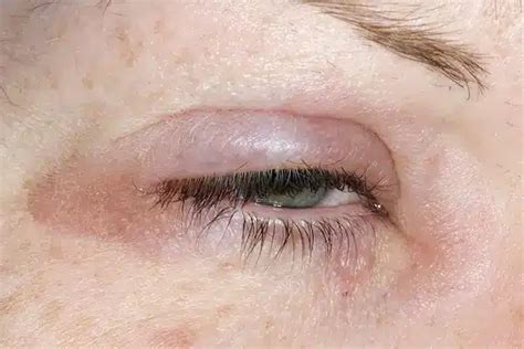 How To Treat A Swollen Eyelid Florida Independent