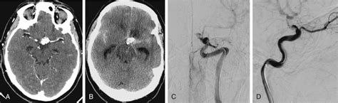 Vascular Injuries During Transsphenoidal Surgery | Neupsy Key