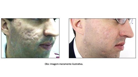 Cicatrizes De Acne Dr Frederico Sanchez