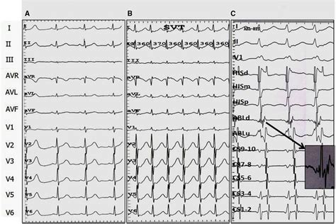 Different Approaches For Catheter Ablation Of Para Hisian Accessory