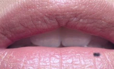 Black Spot on Lips? What’s That About Then? - HubPages