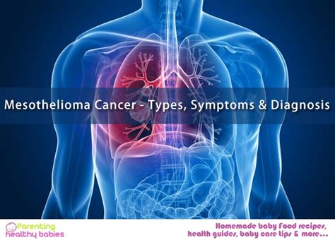 Mesothelioma Cancer Types Symptoms Diagnosis