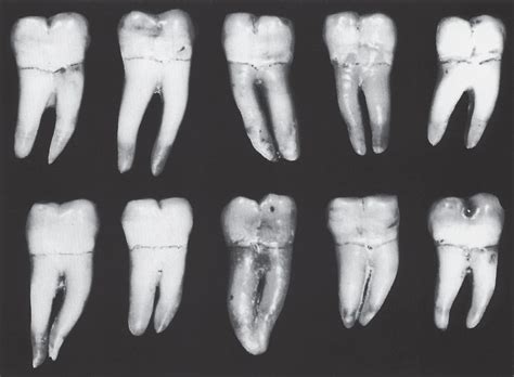 Dentosphere : World of Dentistry: Mandibular Second Molar - Curved root ...