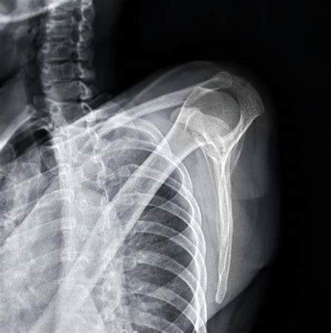 X Ray Shoulder