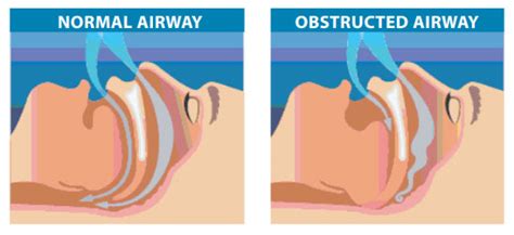 Obstructive Sleep Apnea Icd 10 Causes Treatment And