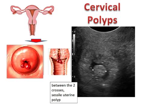 Cervical Polyps