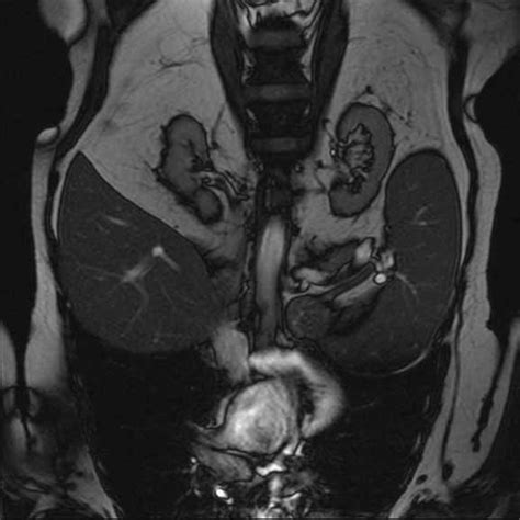 Magnetic Resonance Imaging Mri Finding Of Splenomegaly Download Scientific Diagram