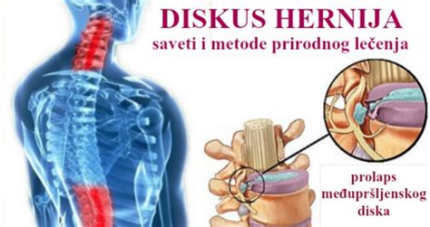 Kako Izlije Iti Diskus Herniju Prirodnim Putem Bez Odlaska Na