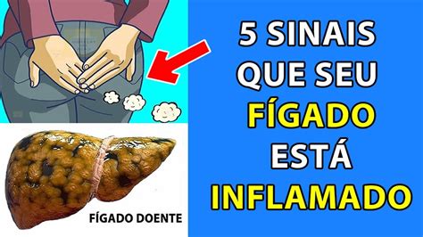 5 SINAIS QUE SEU FÍGADO ESTA INFLAMADO YouTube